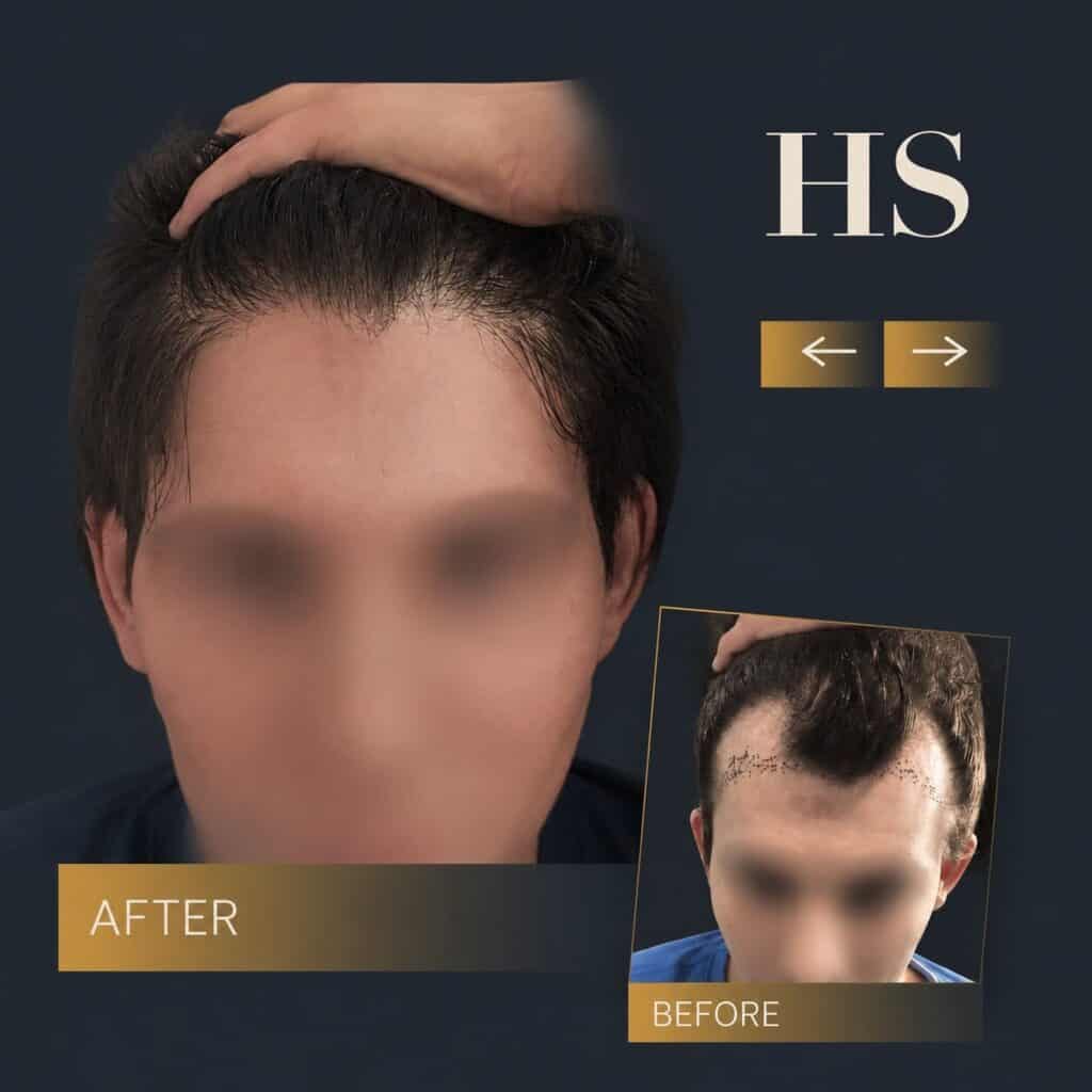 Transgender Hair Transplant 1 Charlotte Harley Street transgender hair transplant before and after