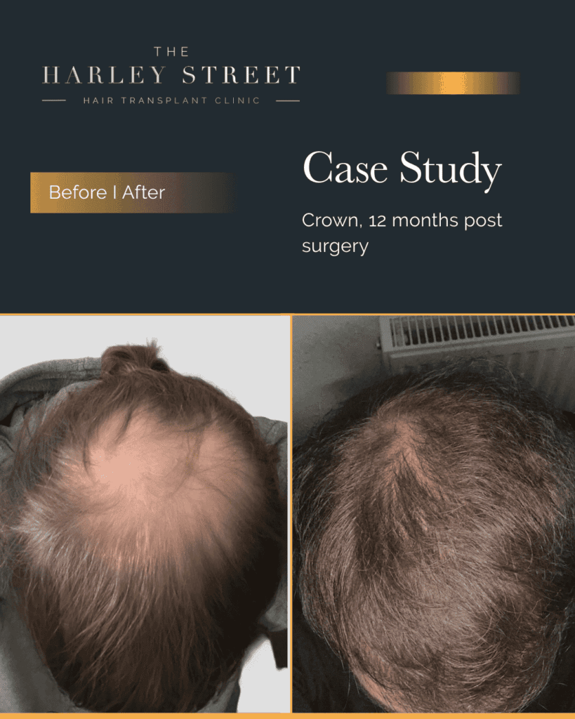 Crown Hair Transplant 1 Harley-Street-HT-pt-Wagstaff-crown