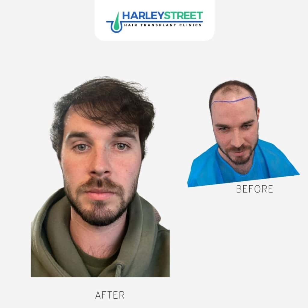 Tom-Francis-Before-After
